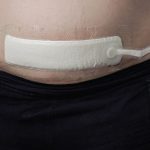 Meta-analysis of negative-pressure wound therapy for closed surgical incisions