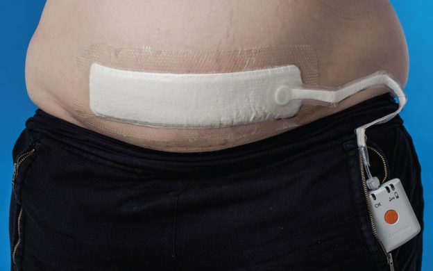 Meta-analysis of negative-pressure wound therapy for closed surgical incisions